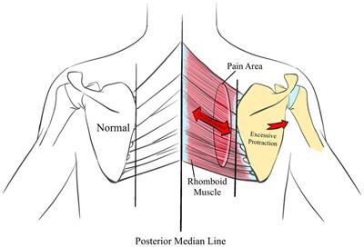 Advancing musculoskeletal diagnosis and therapy: a comprehensive review of trigger point theory and muscle pain patterns